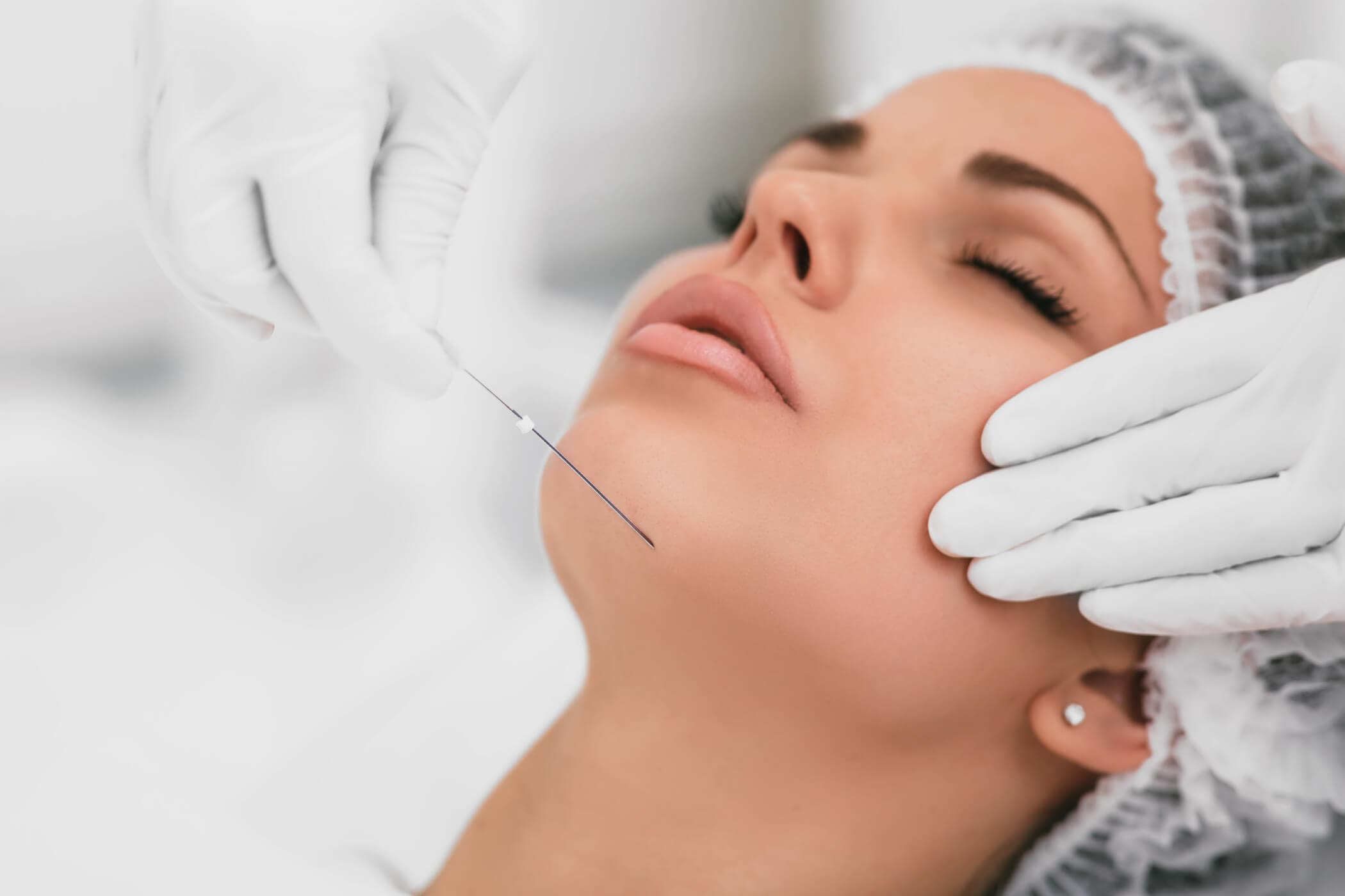 لیفت صورت و رفع افتادگی پوست با نخهای تخصصی PDO
